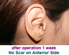 plastic-surgery-prominent-ear 